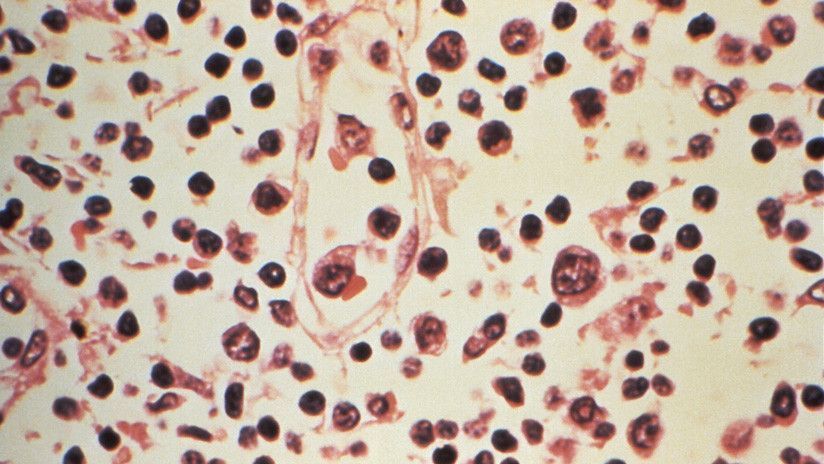 Espécimen de ganglio linfático extraído de un paciente contaminado por Hantavirus. Foto: Reuters